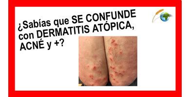 Entrevista Dr. Rodrigo - Celiaquía síntomas parte 4
